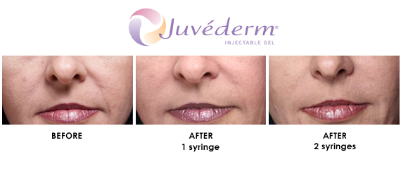 JUVEDERM Treatment: Before treatment, After 1 Syringe, Ater 2 Syringe 