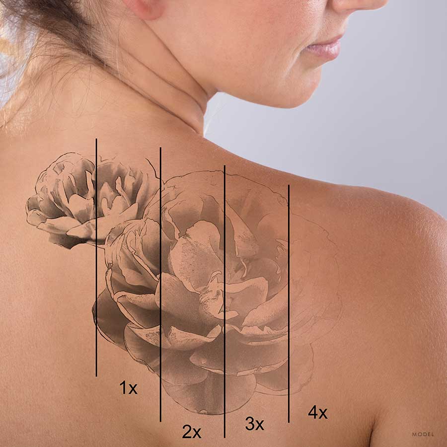 A diagram showing the process of a fading floral tattoo over time on a woman's back
