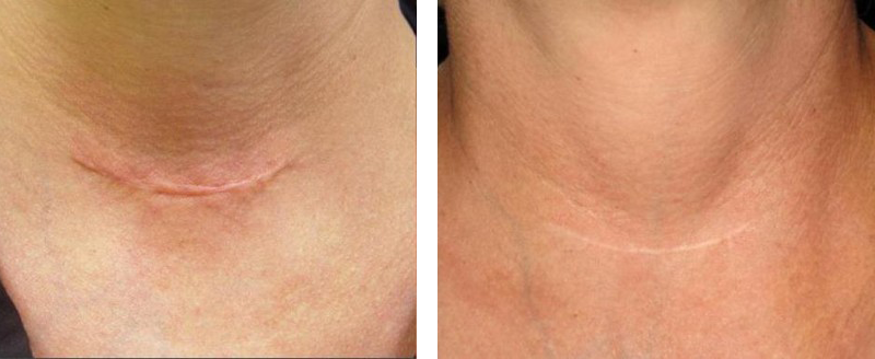 Skin Resurfacing Before and After | Pacific Palisades Plastic Surgery