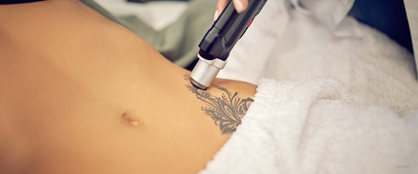 Close up of a tattoo removal device going over a floral tattoo on a woman's stomach