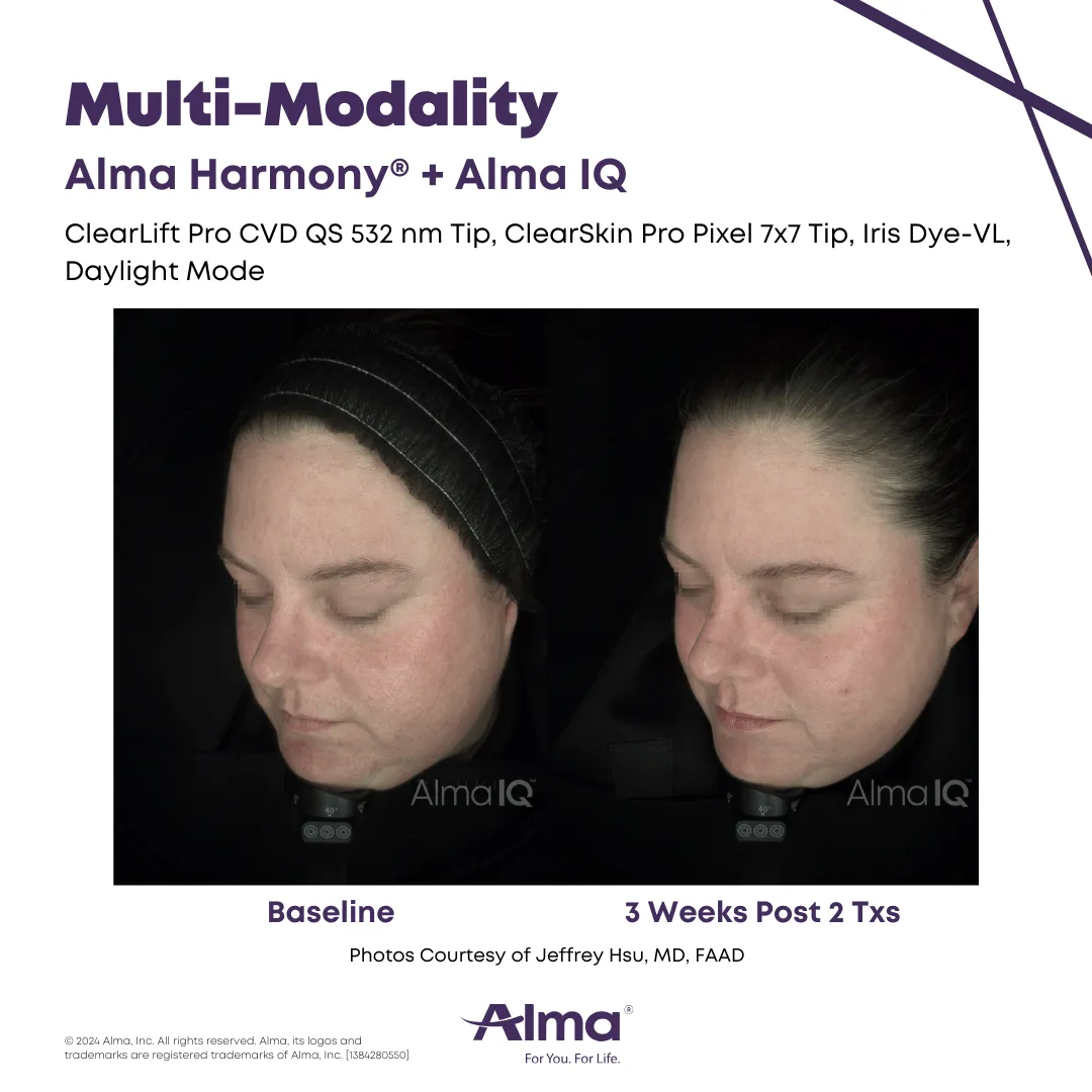 Multi-Modality Alma Harmony + Alma IQ. Photo courtesy of Alma