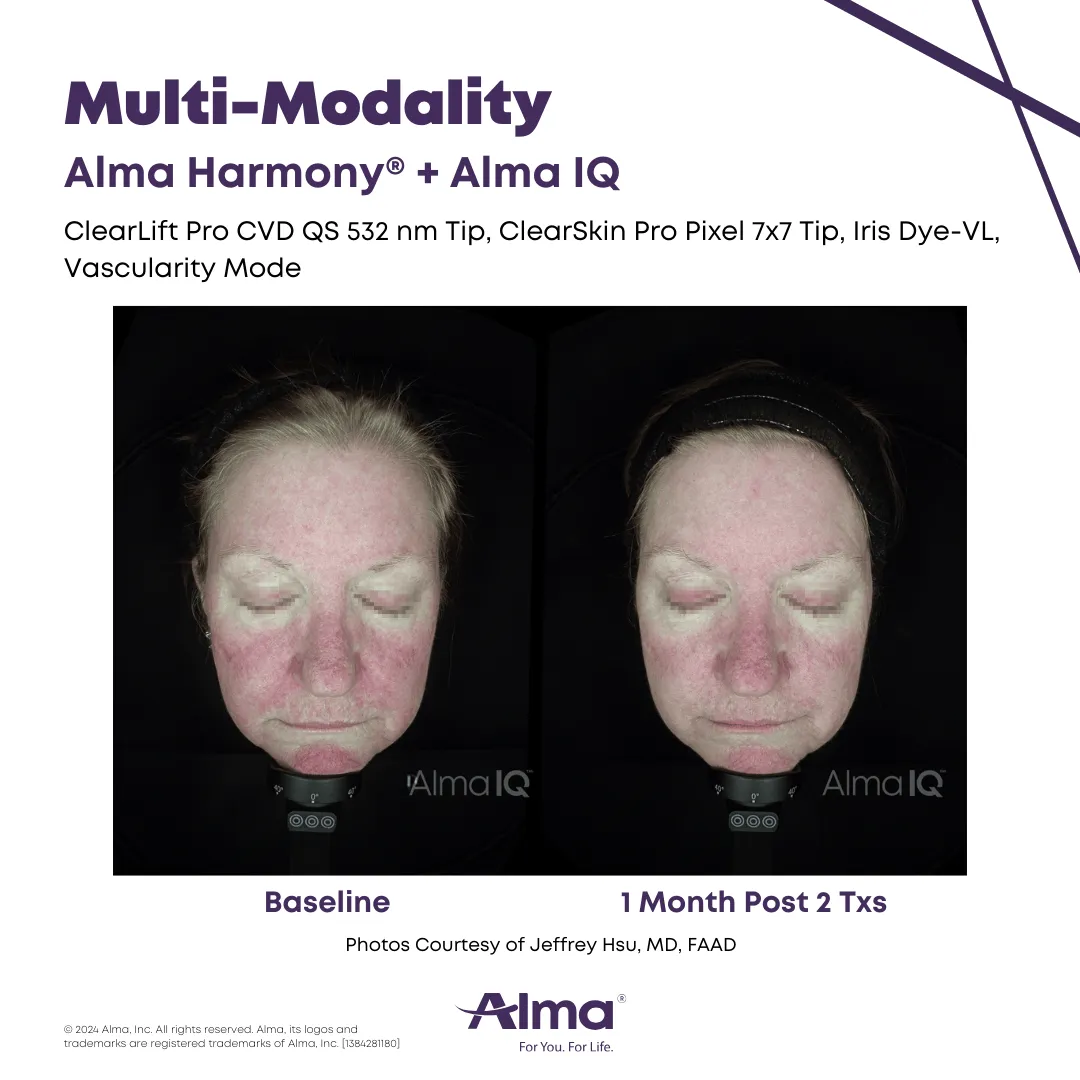 Multi-Modality Alma Harmony + Alma IQ. Photo courtesy of Alma