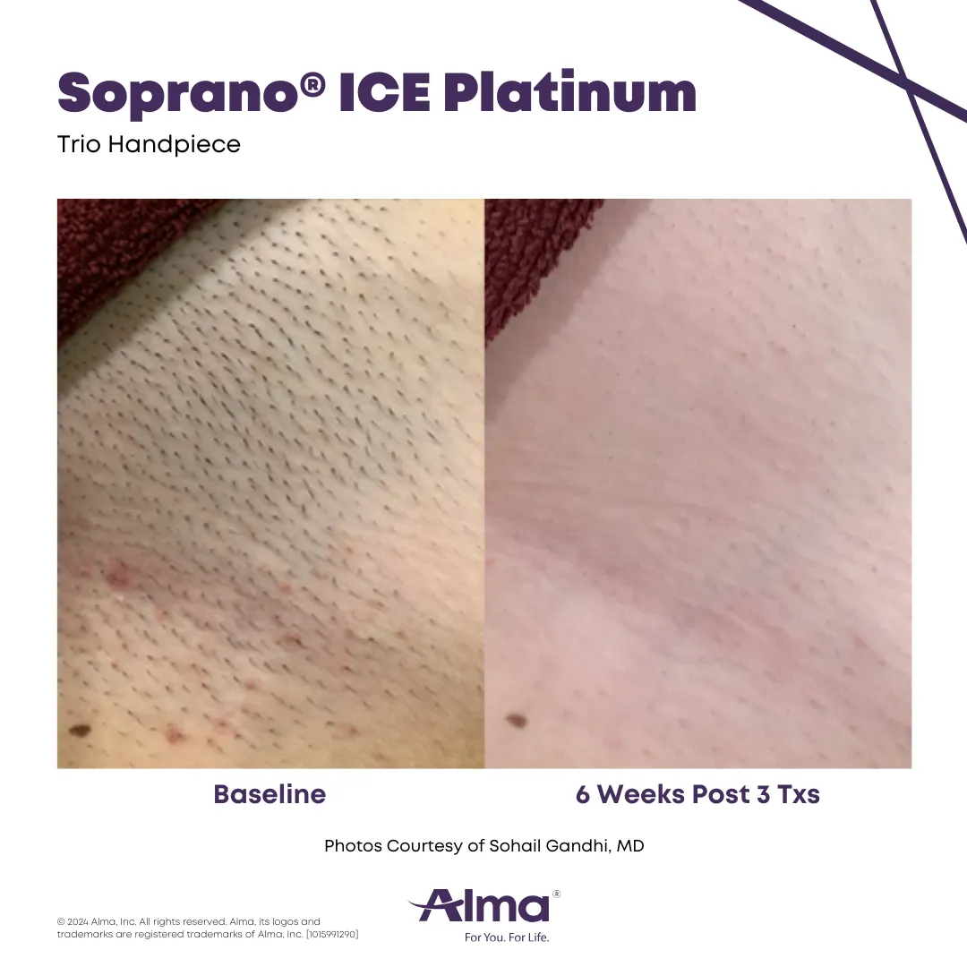 Soprano ICE Platinum before and after. Photo courtesy of Alma